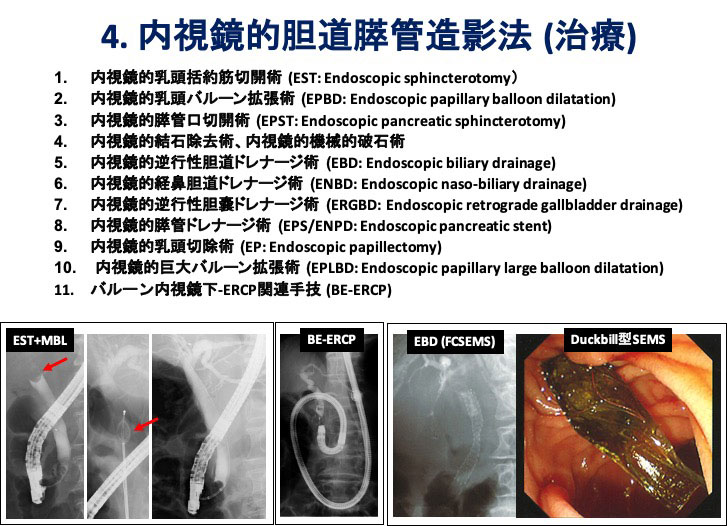 4.内視鏡的胆道膵管造影法（治療）